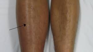 Leg swelling